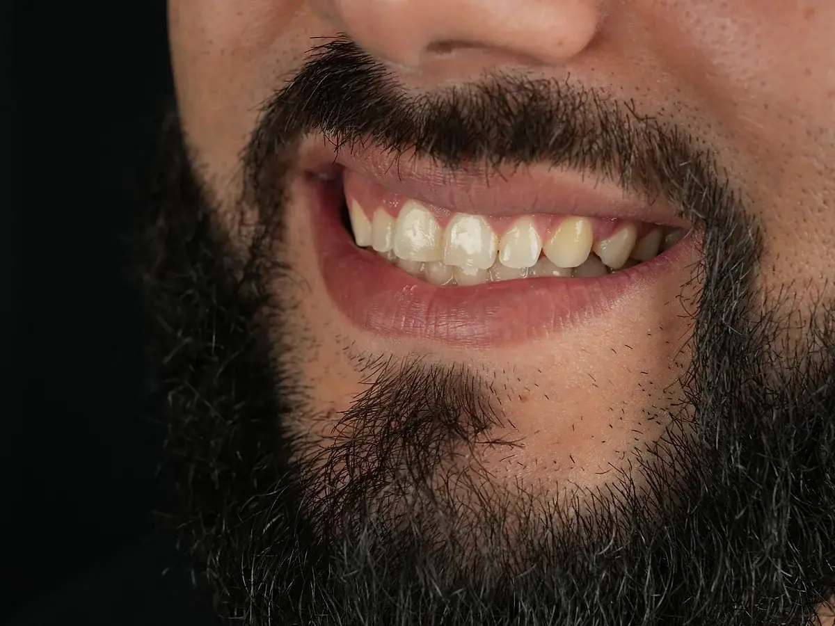 Smile before — Full Smile Transformation
