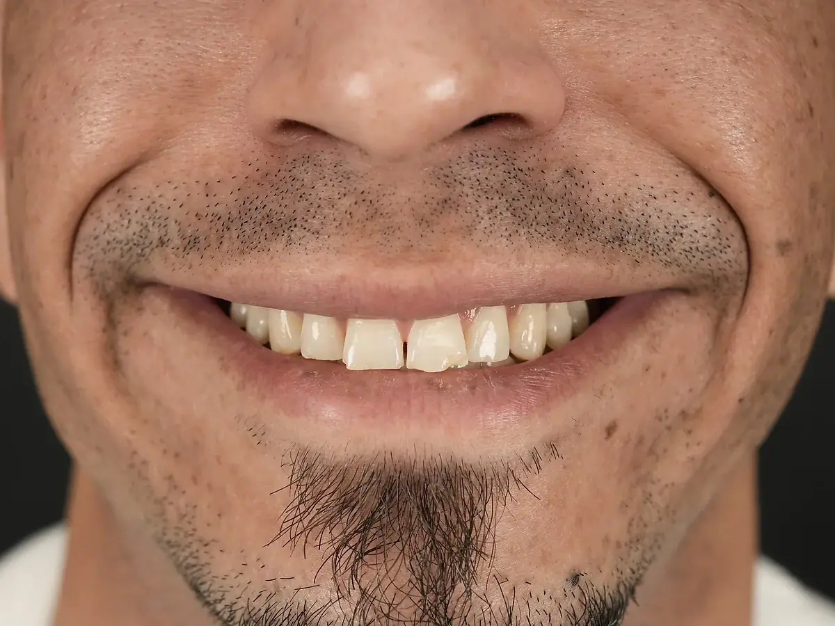 Smile before — Color & Shape Correction