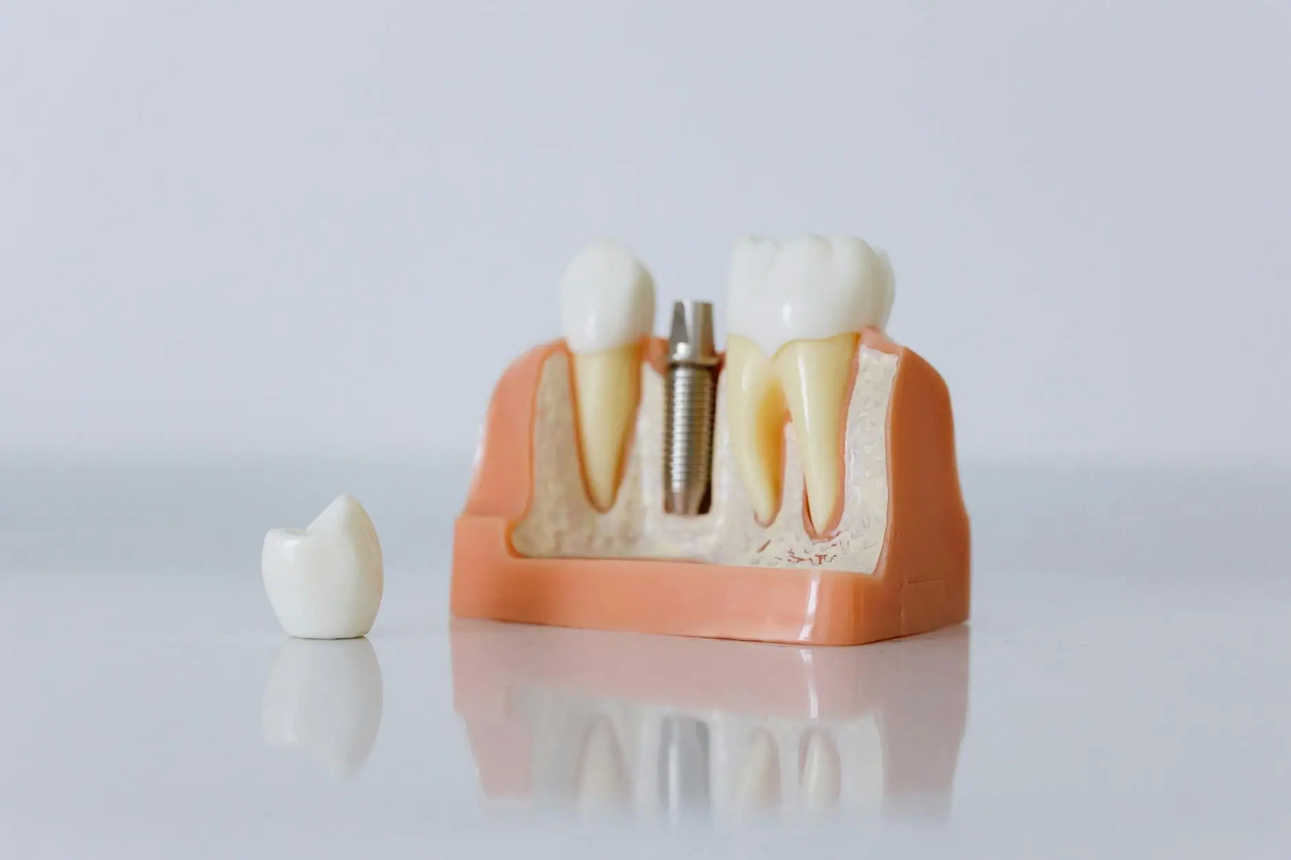 Dental implant treatment · Smile Dental Center Miami 5