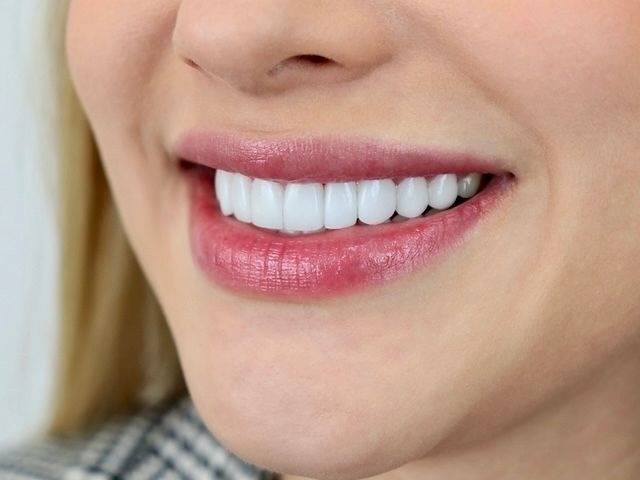 Composite Veneers
