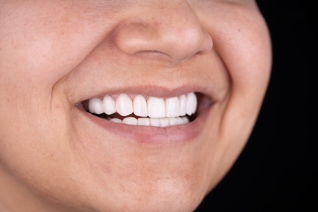 Smile Design