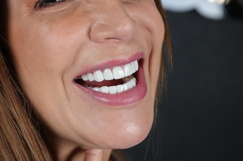 Teeth Whitening