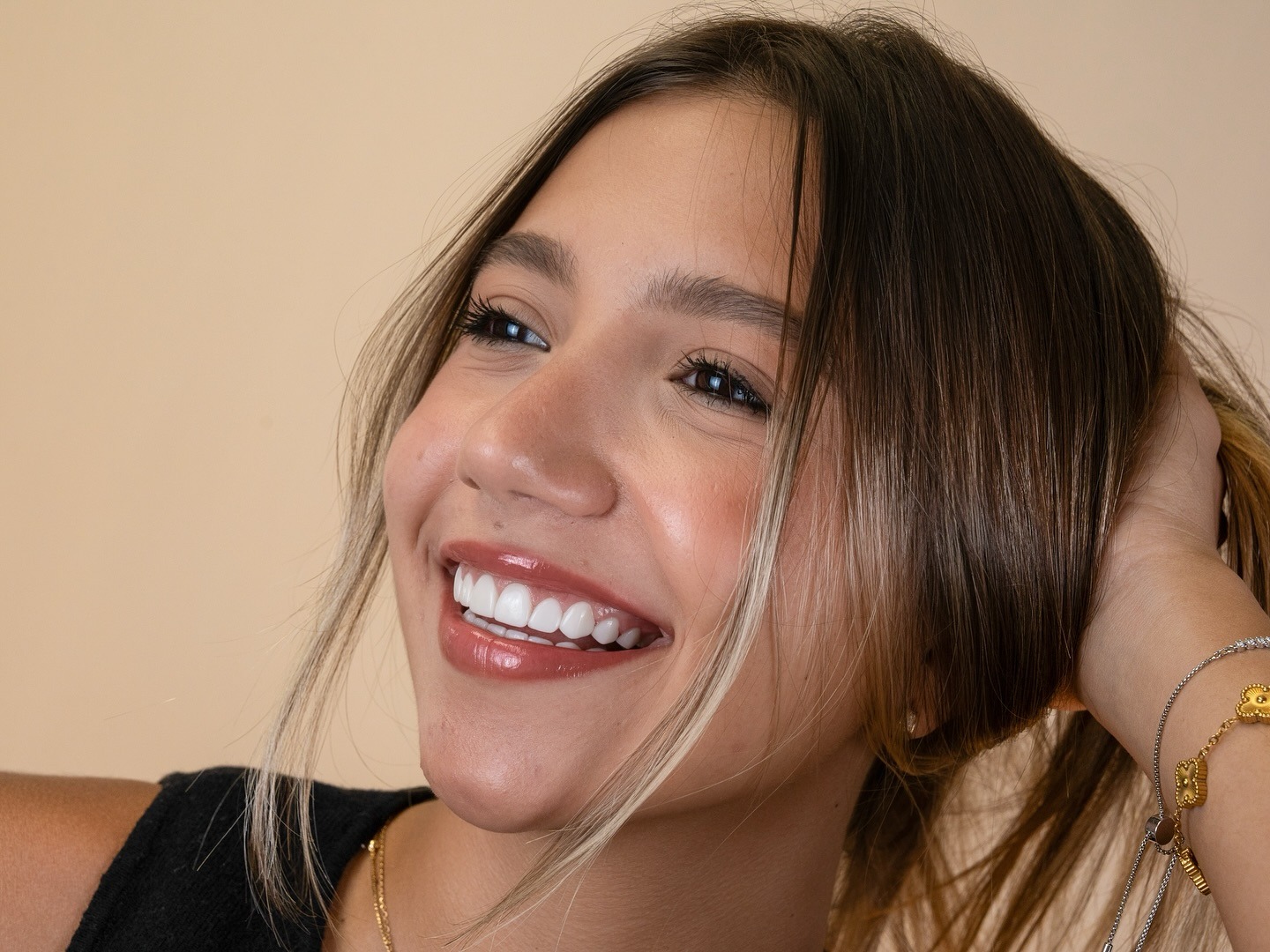 After — Porcelain Veneers