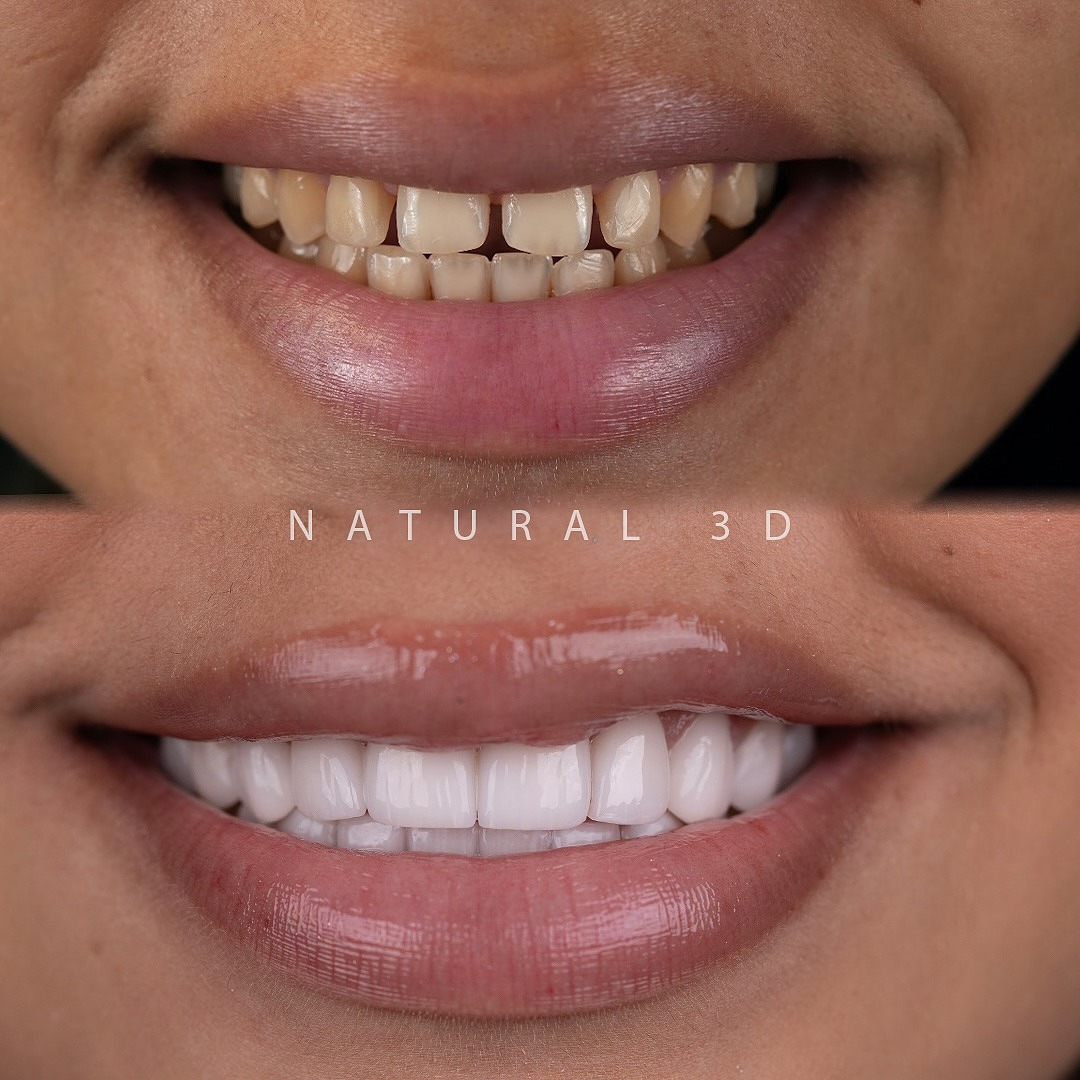 After — Full Smile Design