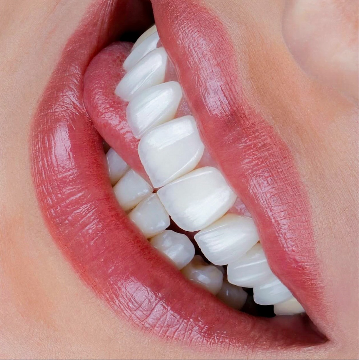 Before — Porcelain Veneers